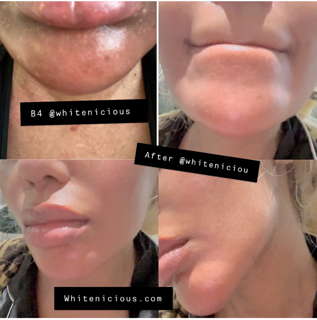 Dark Spot Face & Body Bleaching Cream Blac Chyna                                               60G