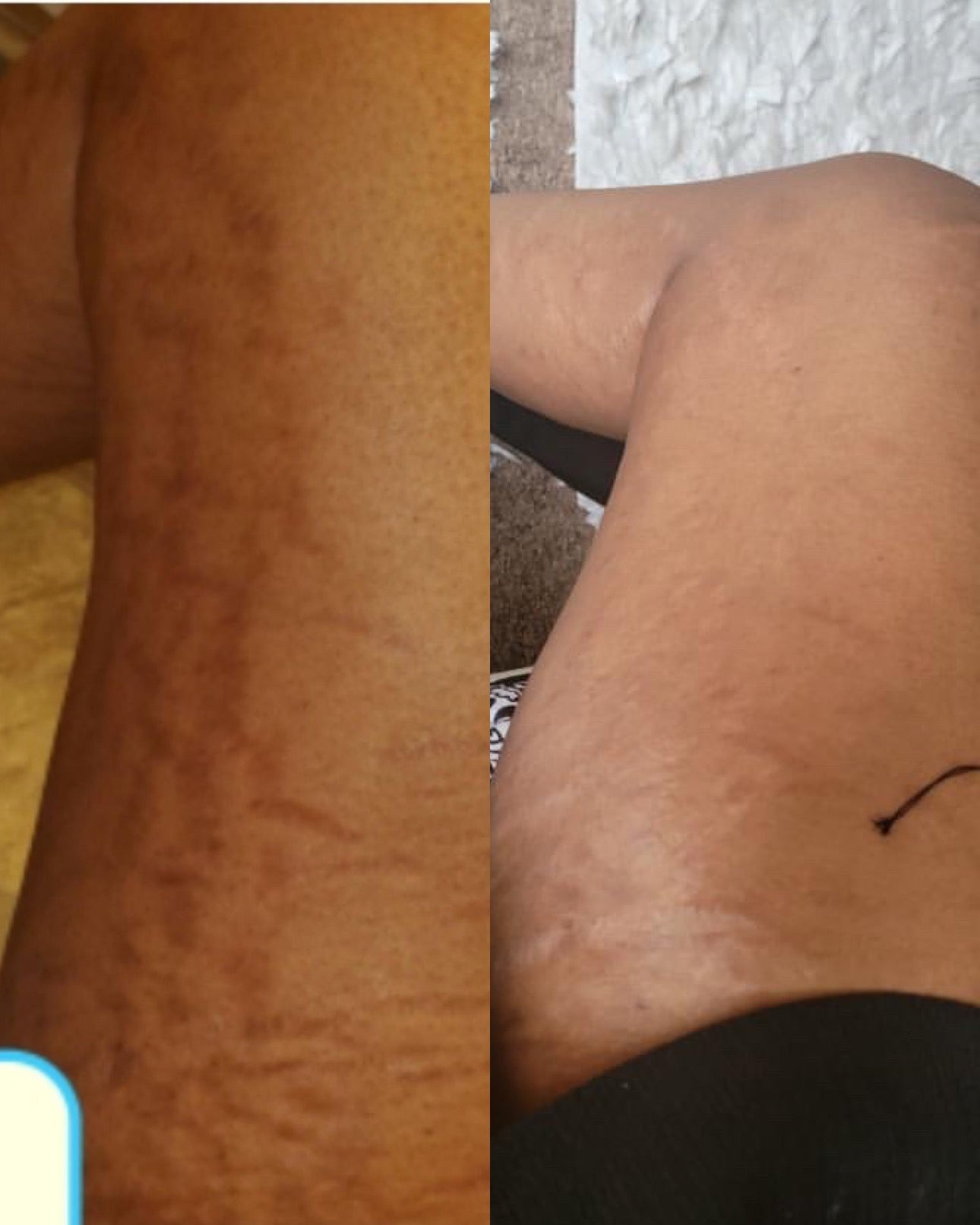 Intensive Stretch Mark Reduction Cream