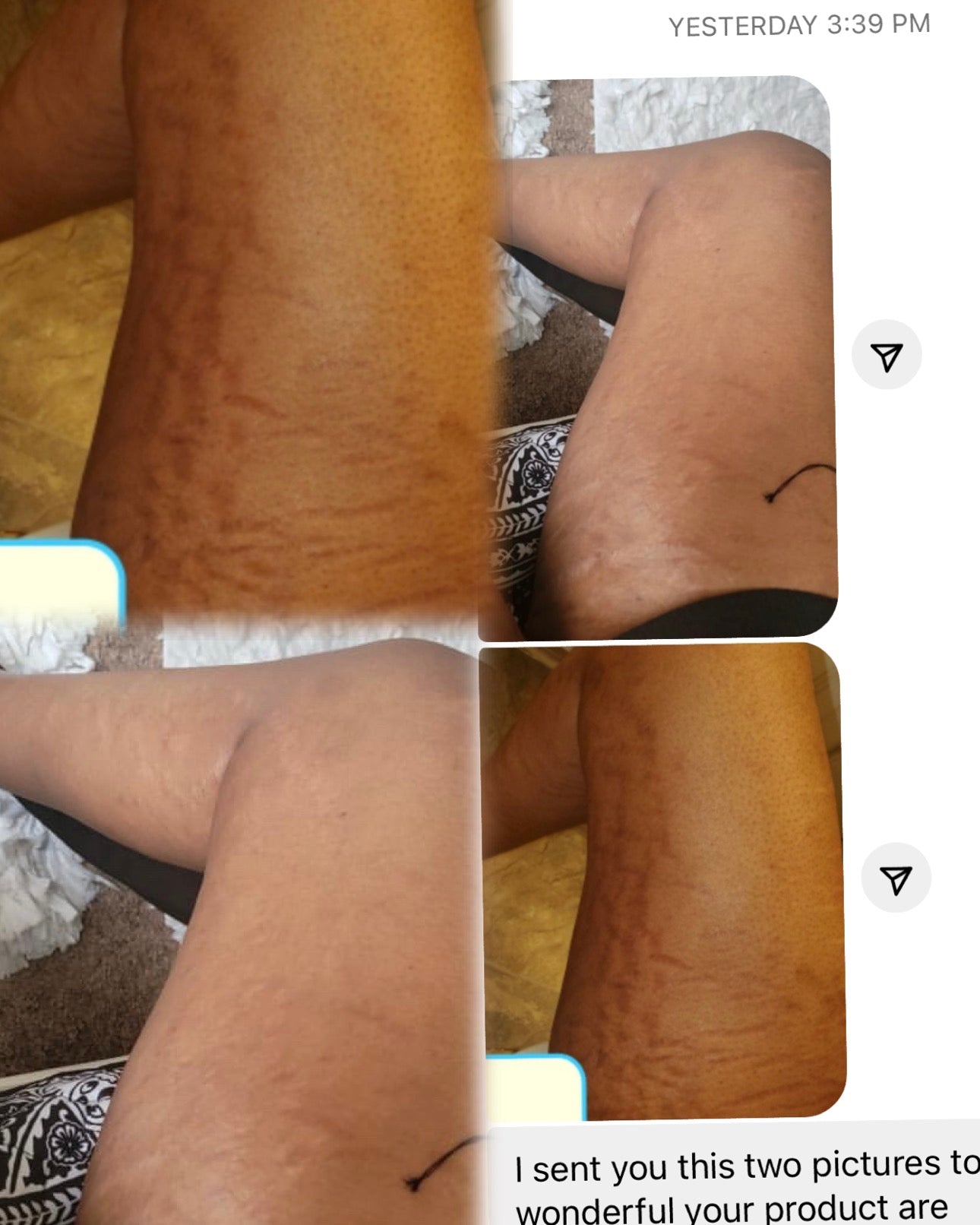Intensive Stretch Mark Reduction Cream