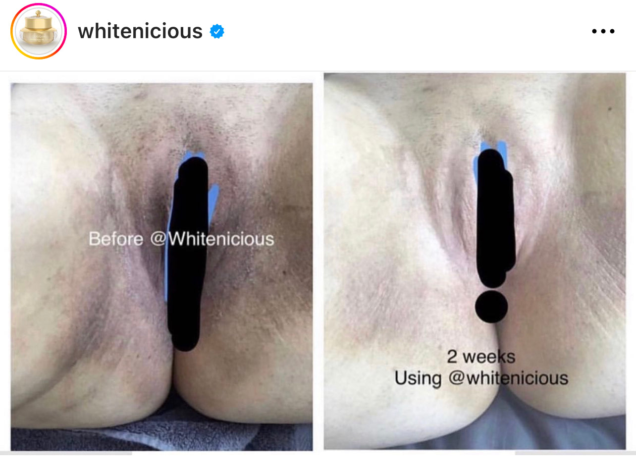 Vagina, Nipples, Anal Bleaching Cream                                             Blac  Chyna                                           15ml | 70ml