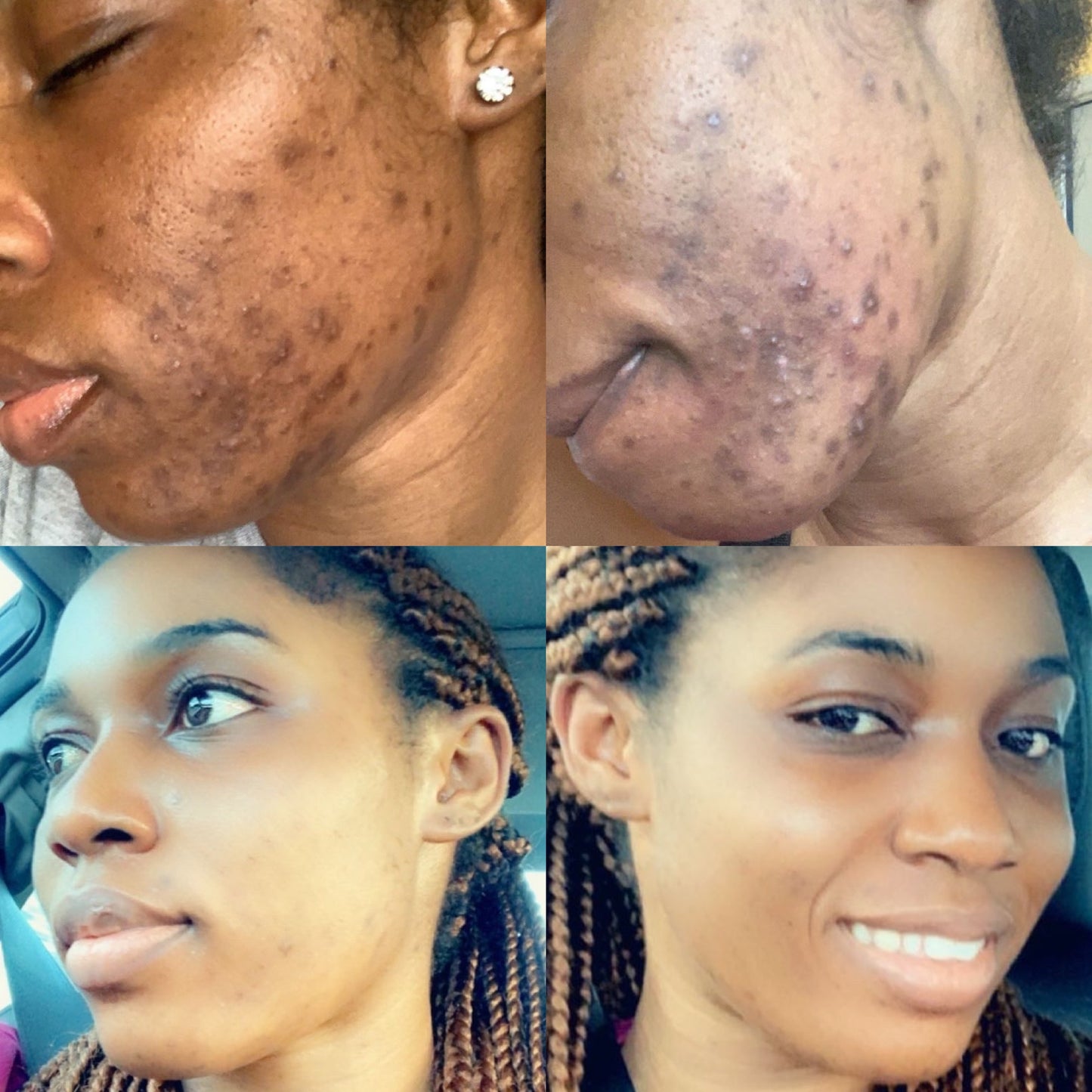 Acne Be Gone Face Set.                                 Blac Chyna