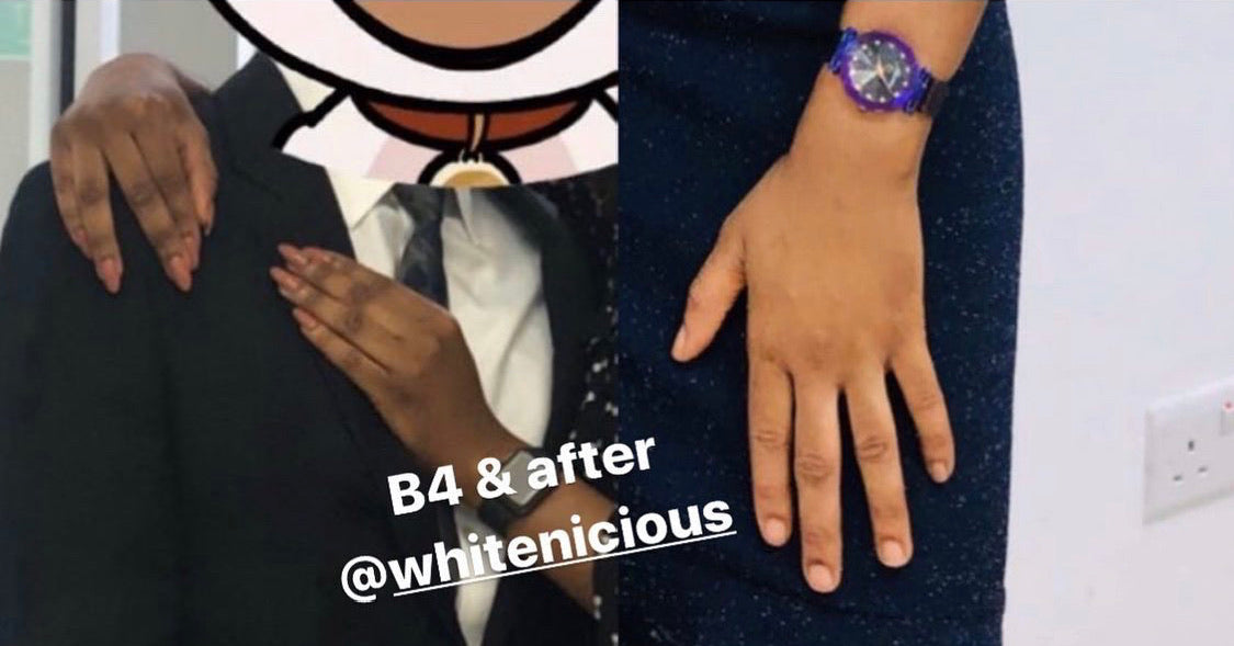 Dark Knuckles,Knees & Elbows Bleaching Cream Set.                                                                     Blac Chyna