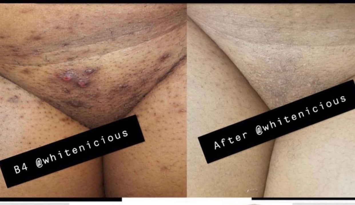 Intimate Areas  Brightening Cream WBD 70Ml