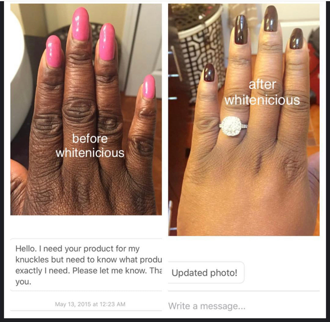 Dark Knuckles,Knees & Elbows Bleaching Cream Set.                                                                     Blac Chyna