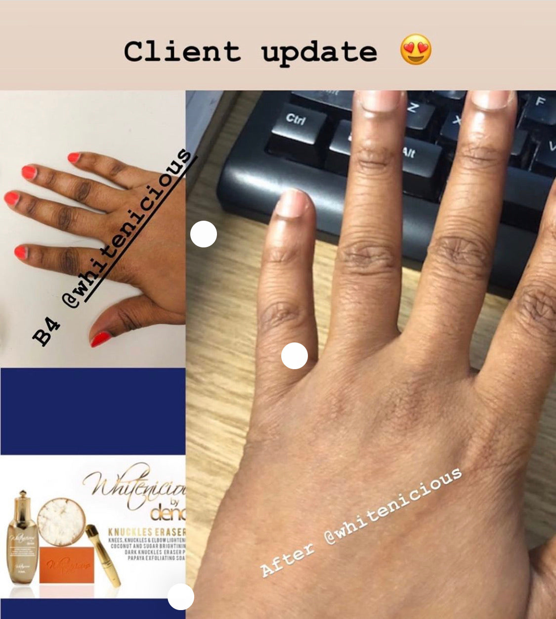 Dark Knuckles,Knees & Elbows Bleaching Cream Set.                                                                     Blac Chyna