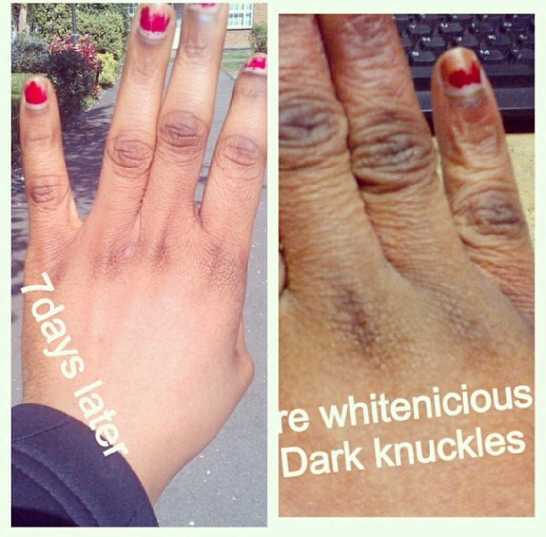 Dark Knuckles,Knees & Elbows Bleaching Cream Set.                                                                     Blac Chyna